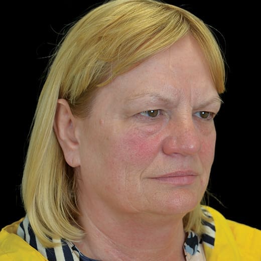 full facelift before